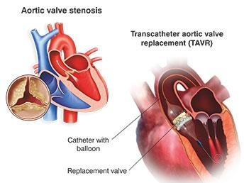 Expert Cardiac Surgeon in Mumbai for Valve Surgery